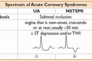 急性冠脉综合征